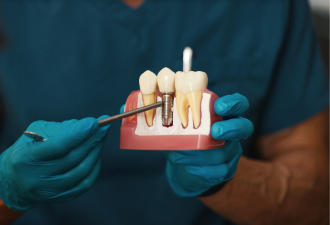 مقالهی ایمپلنت دندان به چه صورت است؟